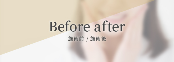 beforeafter